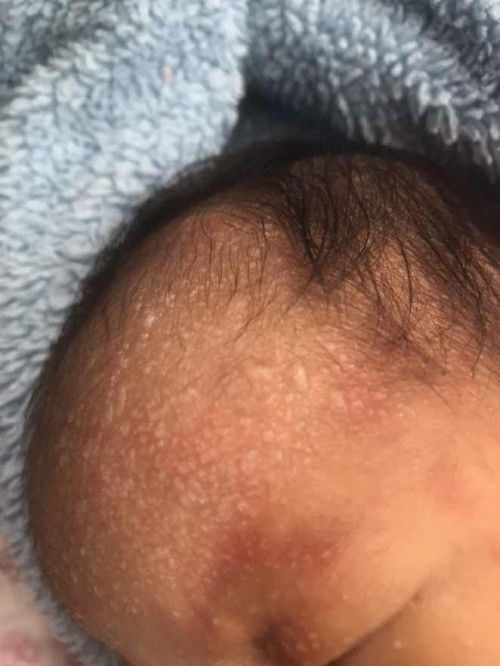 ตุ่มพองน้ำใส  สอบถามแม่ๆ