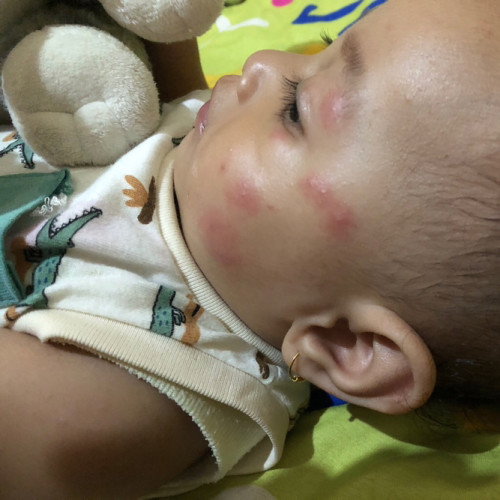 Info obat nyamuk bayi
