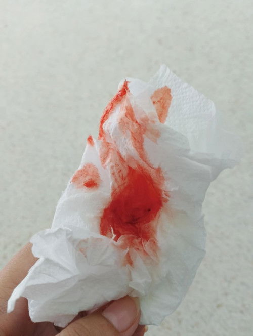 ผ่าคลอด แล้วประจำเดือนมาไวสุดตอนไหน