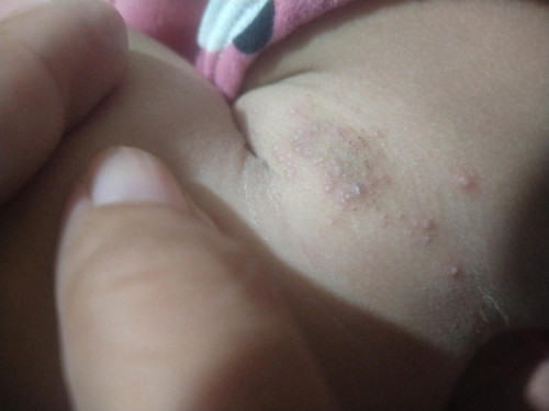 hello po sa lahat newbie po ako here. ask lng po ano po kaya itong tumubo sa leeg nang anak ko?