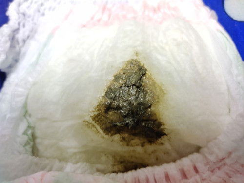 อึสีเเบบนี้ปกติไหม