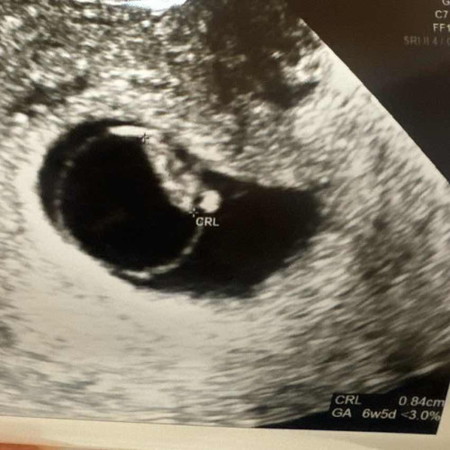 6-9 weeks ซาวเจอตัวอ่อน แต่ไม่พบหัวใจ มีหวังไหมคะ