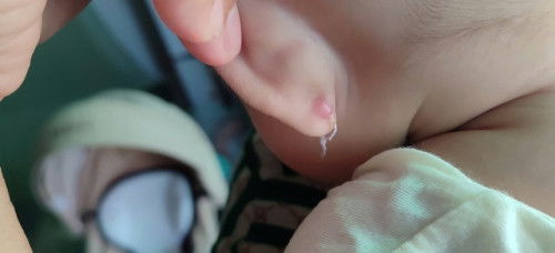 Này có phải là sẹo không ạ, có cách nào để hết không  các mom ơi mình lo quá