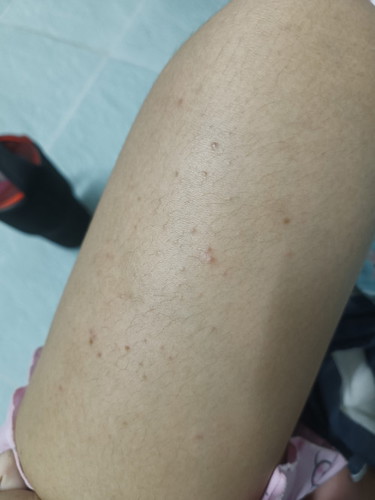 มีตุ่มขึ้นหลังคลอดลูกก่อนหน้านี้ไม่เคยเป็น