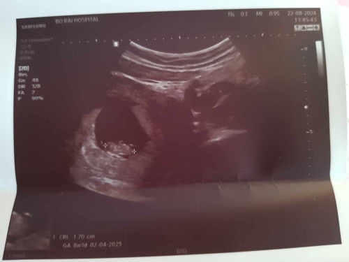 ขนาดของทารกในครรภ์