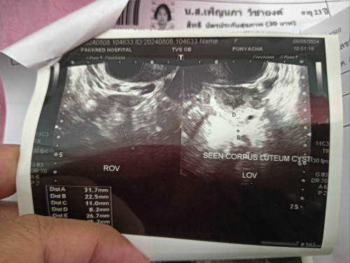 ท้อง7Week มีเลือดออกกะปริดกะปรอย