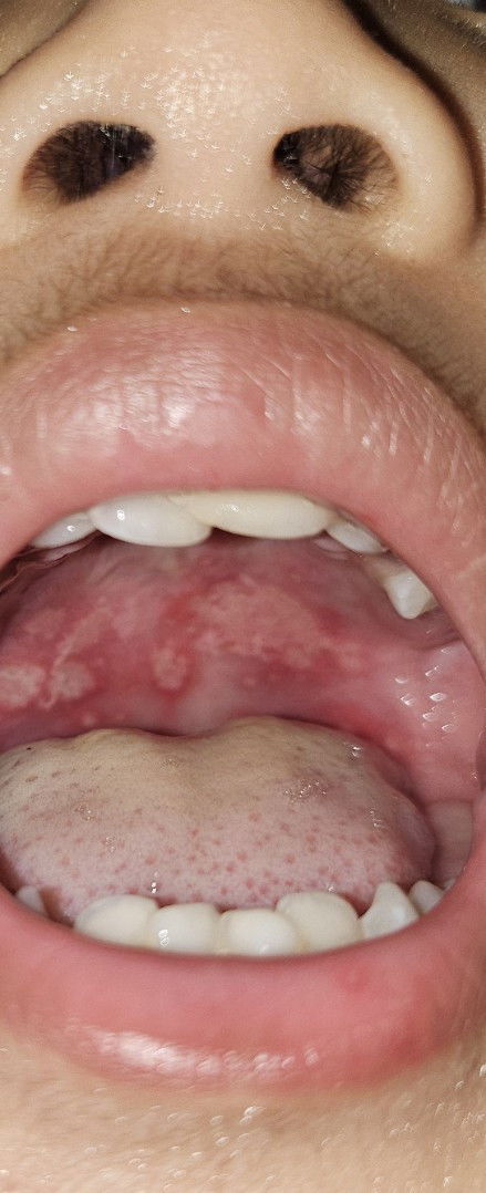 Ini sariawan bukan? Atau karena jamur?