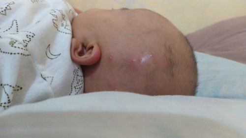 Ada seperti jerawat di kepala anak bayi