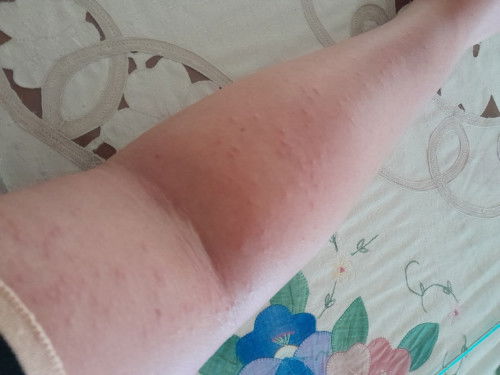 PUPPPP.. (Gatal pada Kulit)