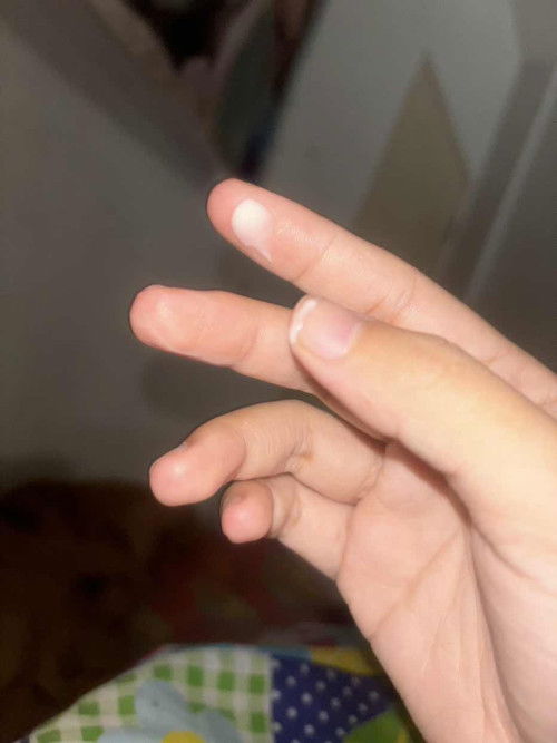 ขออภัยในความน่าเกลียดนะคะ เป็นแบบนี้ไม่คันไม่มีกลิ่นอันตรายมั้ยคะหาหมอแล้วได้ยาสอดมาแต่น้องไม่หาย