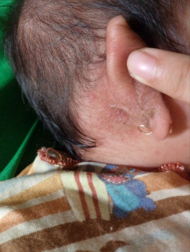 Kenapa ya bayi 1 bulan ada kerak di belakang telinganya seperti ini? Sudah dibersihkan muncul lagi