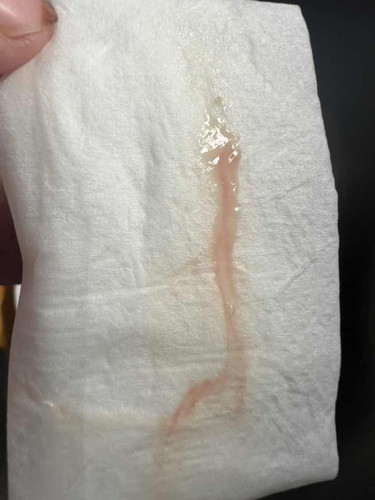 Bleeding atau spotting