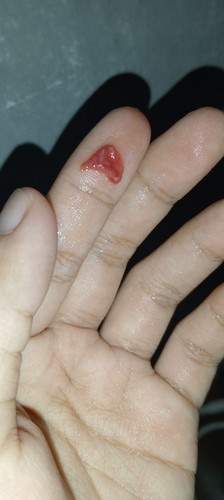 gumpalan darah mcm daging