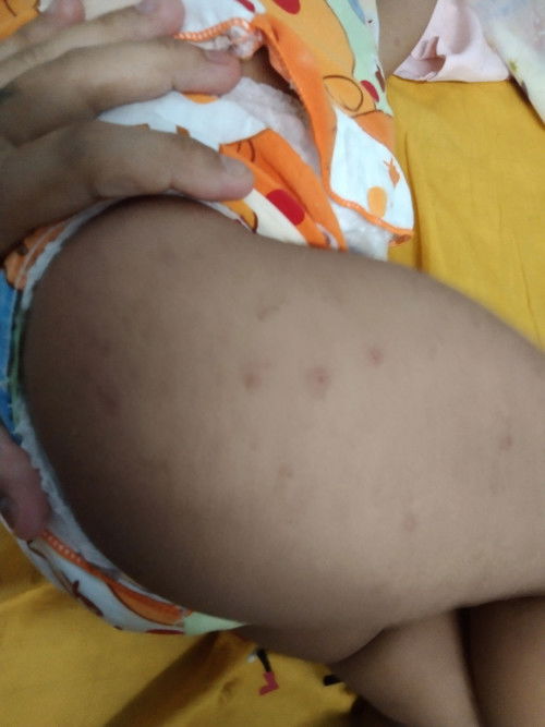 อยากทราบว่าอันนี้เรียกว่าผดไหมคะเพราะว่ามันขึ้นแปลกๆ