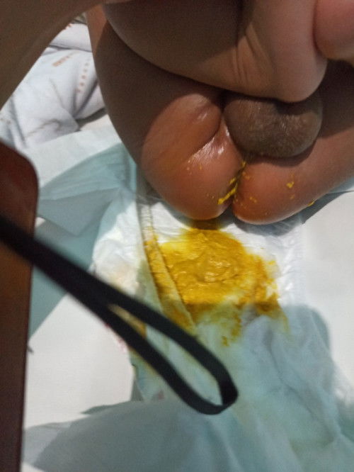 Bayi 1,5 bulan mencret hrs gmn ya