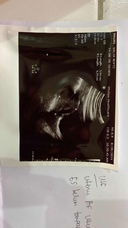 Tes positif, tapi belum ada janin