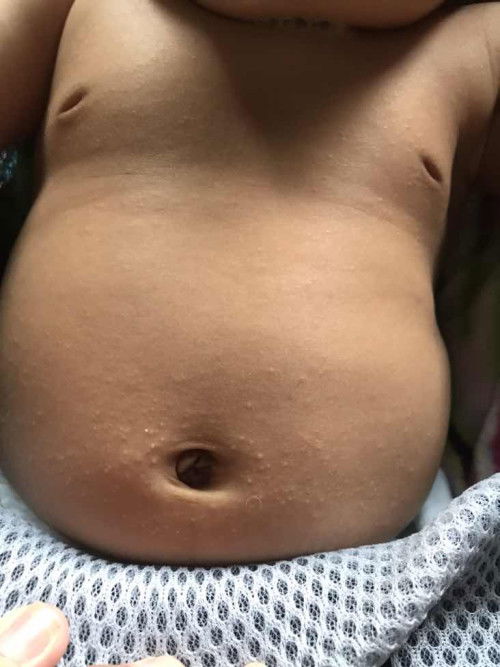 Alergi pada perut anak