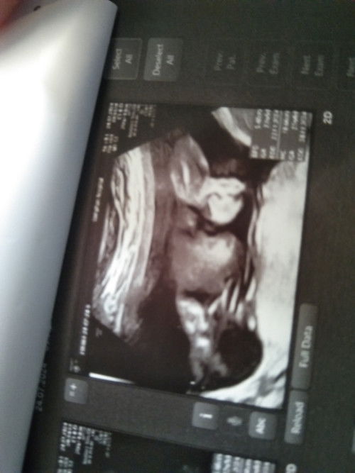 ภาพนี้รูปหน้าเด็กใช่มั้ยคะ ดูแปลกๆ😂 ภาพตอน22วีคค่ะ  ขอดูรูปหน้าทารกของเเม่ๆหน่อยค่ะ🥰