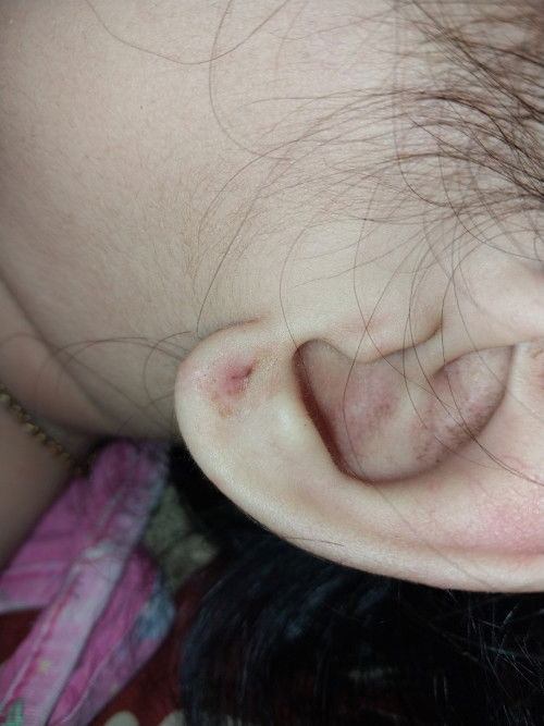 anak saya sudah 2 thn 4bln ceritanya mau ganti anting pas copotin ternyata tindikannya robek