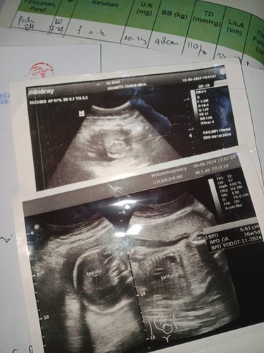 Hallo saya mau nanya ini hasil foto USG pas usia kandungan 26week hasilnya normal semua ga,