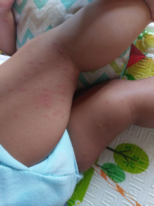 Bintik merah banyak  , biang keringat apa bukan