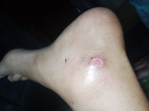 Normal lang po na magkaroon ng mga sugat ang isang buntis? Ano po ang maaari kong gawin?
