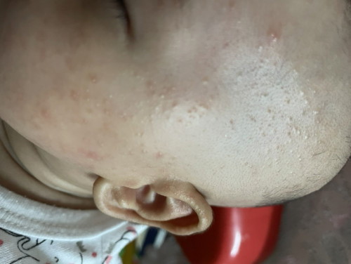 Ruam di Muka Baby