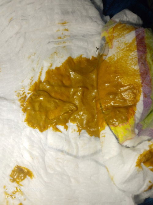 Normal po ba ang mabahong poop ni baby ay amoy bugok  na itlog at parang twice lang poop in 1 week?