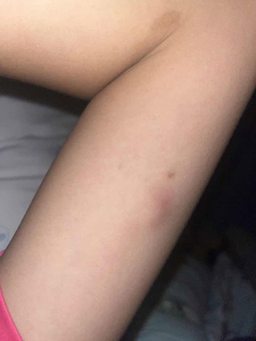 แม่ๆบ้านไหนฝังยาคุมบ้างคะ