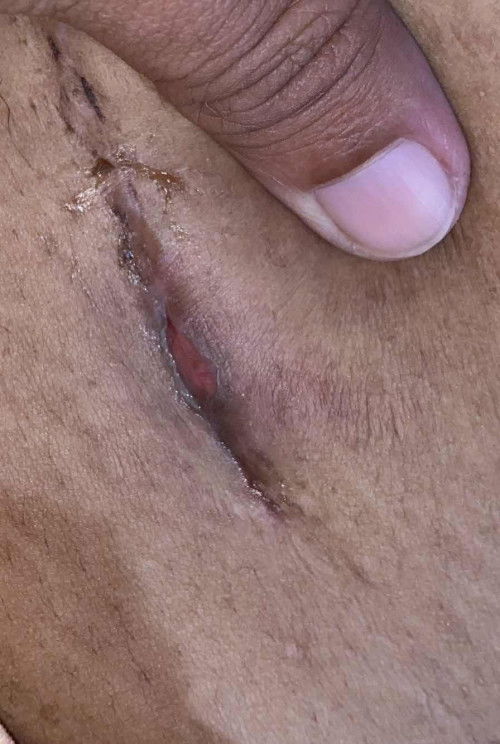 Luka cesar terbuka dan bernanah