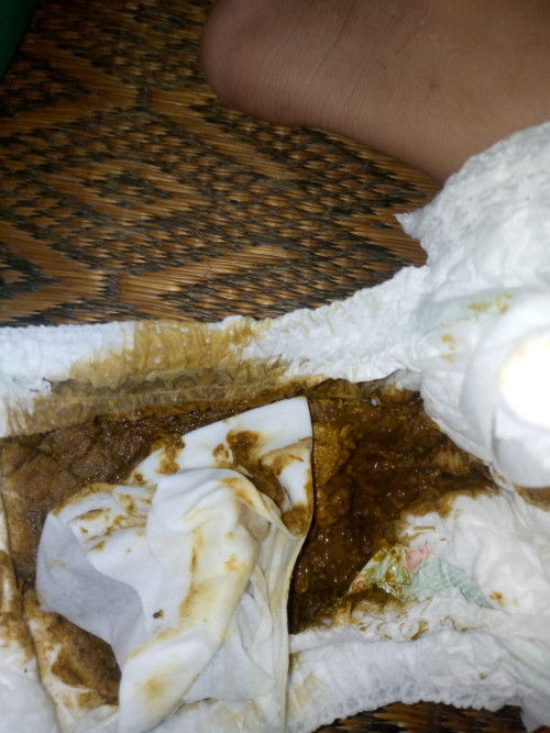 น้อง1ขวบ1เดือน5วัน อีสีนี้ปกติมั้ยคะ