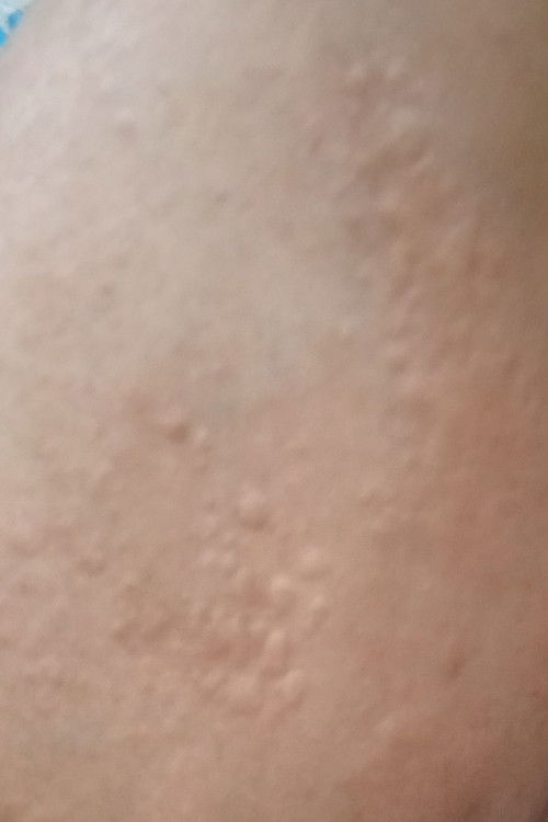 Usia kandungan 9w4d ada yg pernah kaligata/Biduran gaa ?