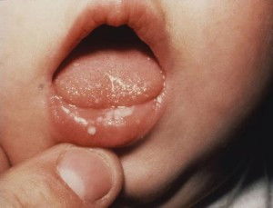 Đốm trắng trên môi lưỡi và hàm trên rơ hok ra còn bj lang ra nhìu nửa bé cx biến ăn các mom có cách