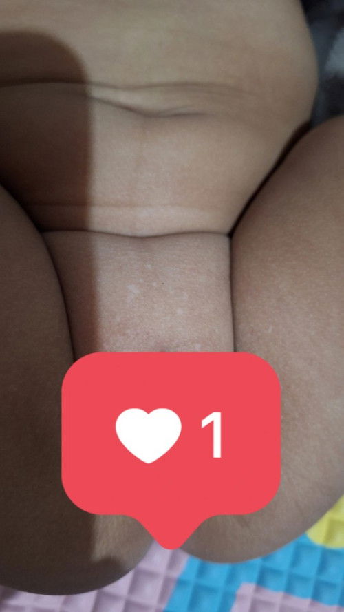 Bercak putih dekat kemaluan bayi