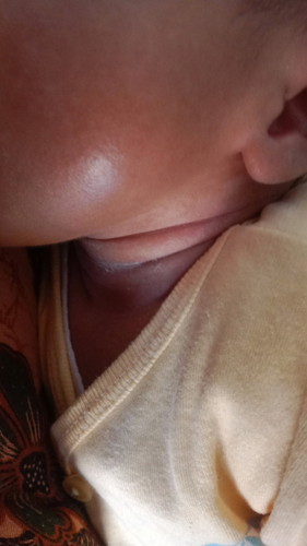 Ruam padi bayi 1 bulan