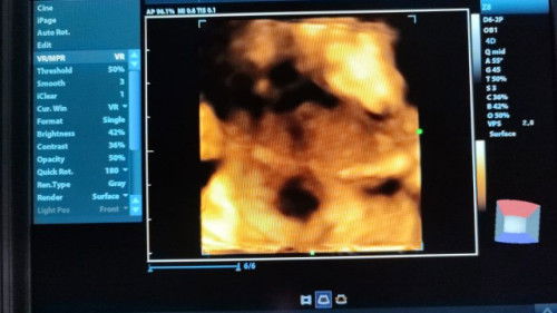 Aku tiba2 dinyatakan hamil 5 minggu 2 hari,saat USG, namun di testpack negatif, ada yang sama?