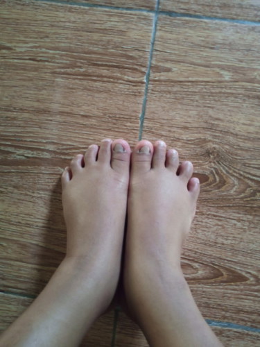 Kaki bengkak