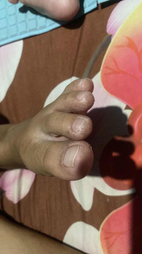 jari kaki pecah” & bekas gigitan nyamuk di betis