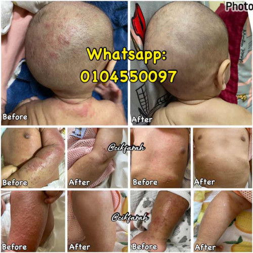 Anak Eczema