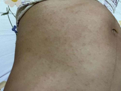 Gatal bintil merah di perut