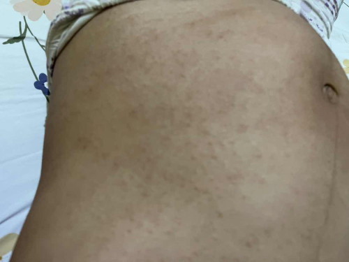 Gatal bintil merah di perut