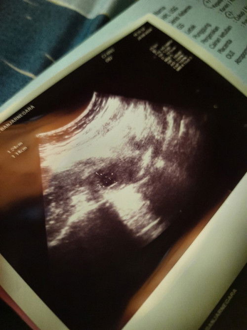 Hamil 7weeks 5 days, ada kista