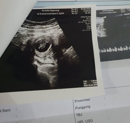 USG Pertama pas 7w4d