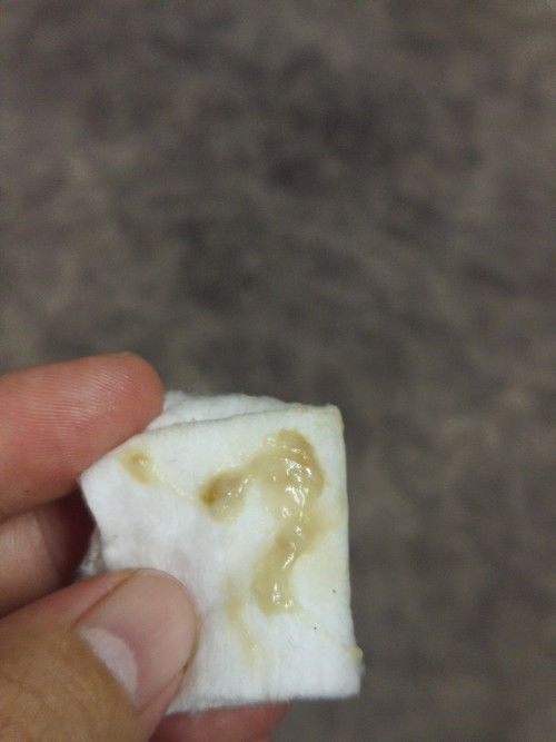 แบบนี้เป็นมูกเลือดมั้ยคะ