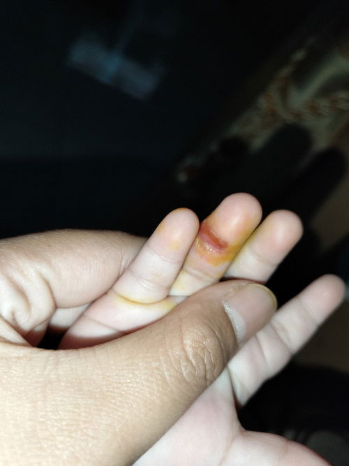 Bun anaknya pernah ada yang begini nggak, tiba tiba melepuh. Dikasih apa ya biar cepet sembuh...