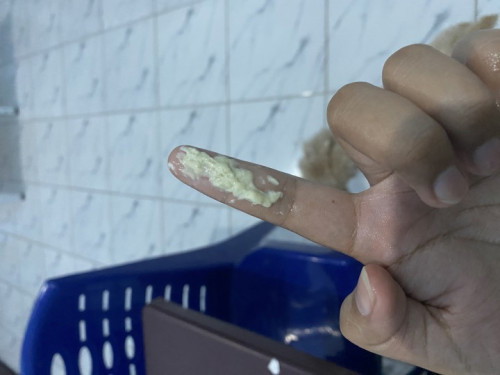 Mengatasi keputihan seperti pecahan tahu