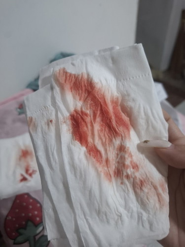 BLEEDING DURING PREGNANCY