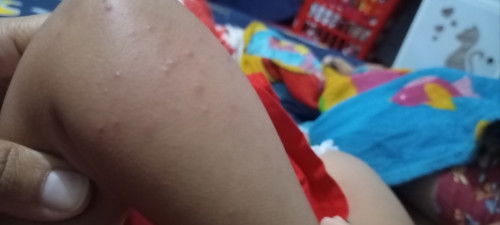 Ruam di sekujur tubuh anak
