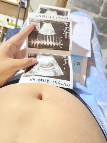 33w+3 🩷🤰🏼 ตอนนี้น้ำหนักลดลง2กิโล เป็นกรดไหลย้อนด้วย อันนี้ปกติมั้ยคะ