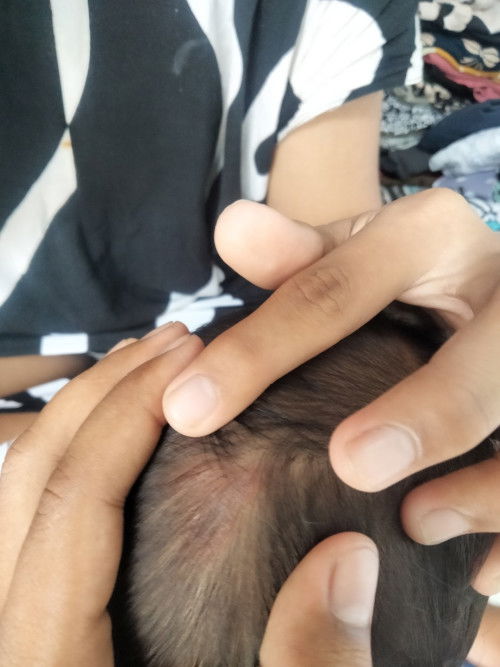 Kulit kepala merah merintis